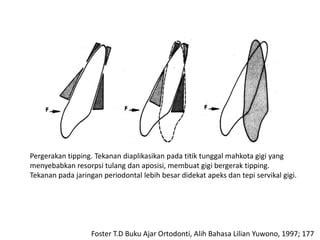 gigi tipping|biomekanika pergerakan gigi .